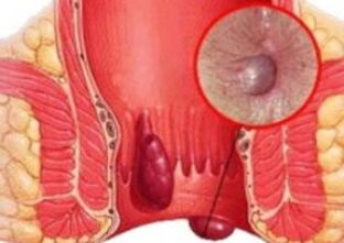 Wie sehen Hämorrhoiden aus